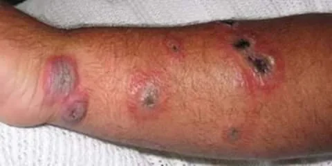 ŞARBON HASTALIĞI CAN ALDI