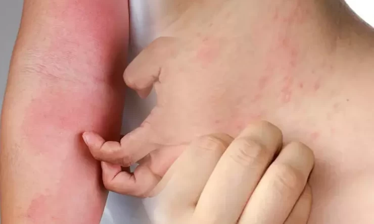 Uyuz Vakaları Hızla Artıyor: Uzmanlar 15 Dakika Temasın Bile Riskli Olduğunu Uyarıyor